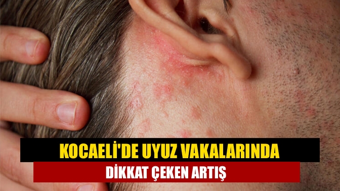 Kocaelide Uyuz Vakalarında Dikkat Çeken Artış