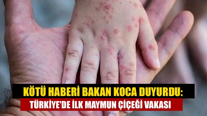 Kötü haberi Bakan Koca duyurdu: Türkiyede ilk maymun çiçeği vakası